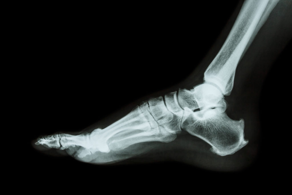 Foot-Xray-1024x683.jpg