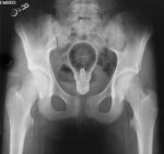 Lightbulb-in-butt_x-ray.jpg
